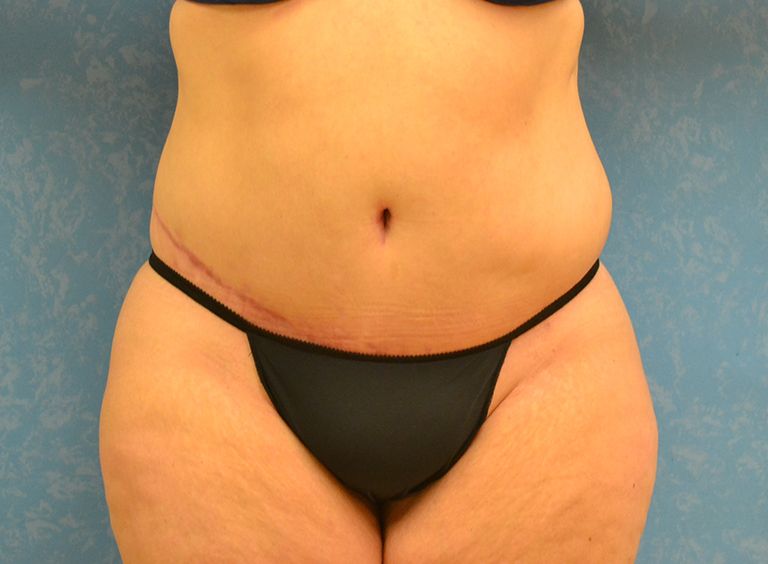 After tummy tuck procedure