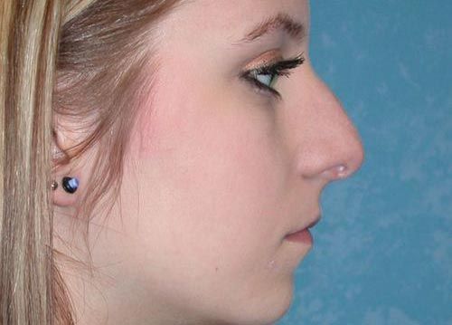 a woman's nose before rhinoplasty