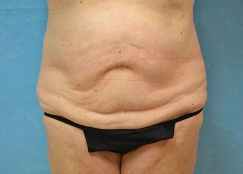 woman's midsection before tummy tuck