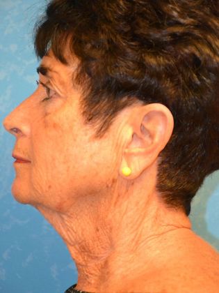 a female's face before facelift